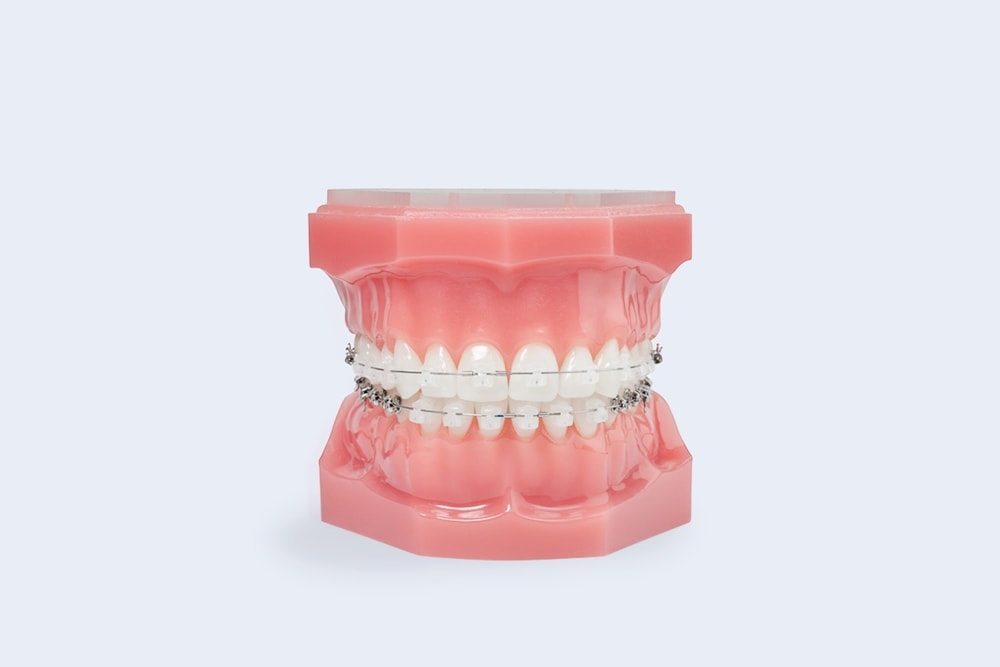 Types of Braces in Geneseo NY