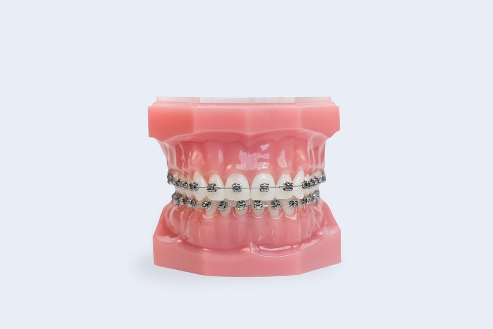 Metal Braces Vs Clear Braces - Scantlebury Orthodontics